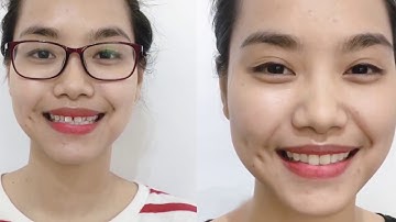 Răng thưa, răng dị dạng sửa thế nào cho đẹp?