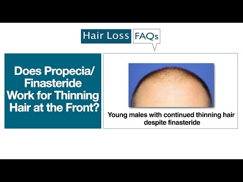 does-propecia/finasteride-work-for-thinning-hair-at-the-front?