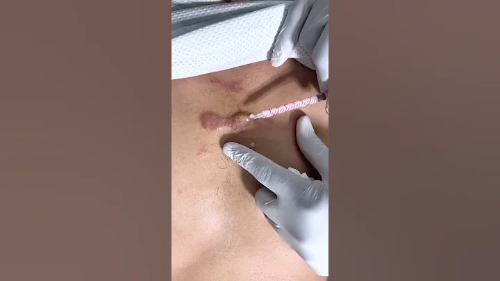 How to treat keloid scar | Keloid Removal Treatment | Remove keloid by injection |  Skinaa Clinic - DayDayNews