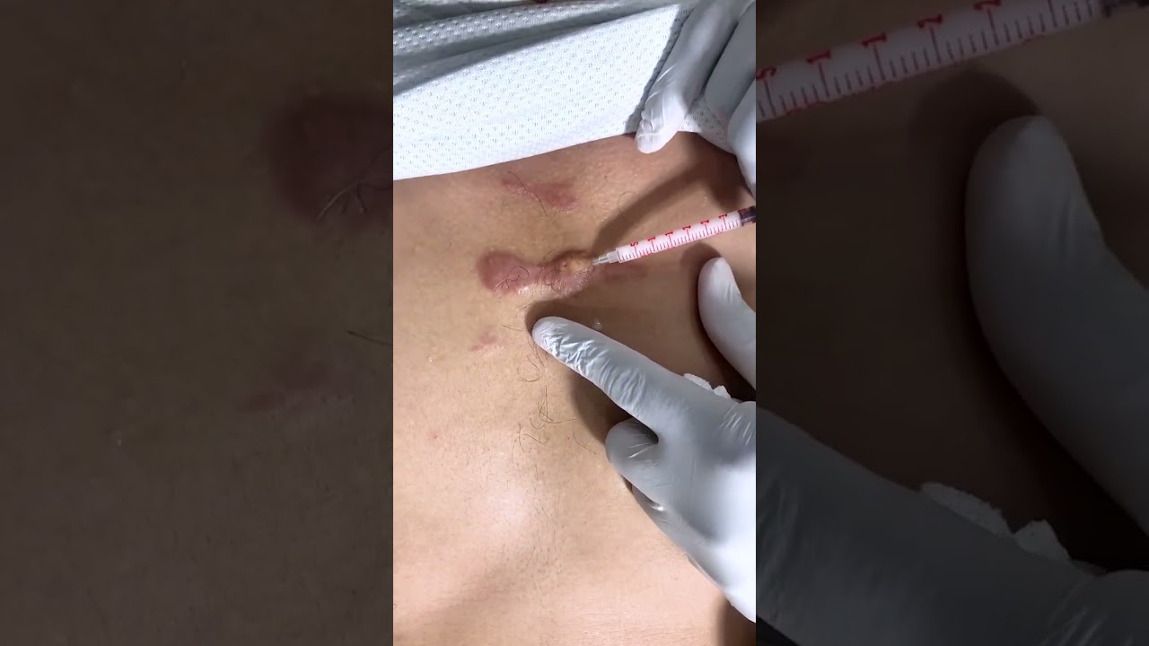 How to treat keloid scar | Keloid Removal Treatment | Remove keloid by injection | Skinaa Clinic