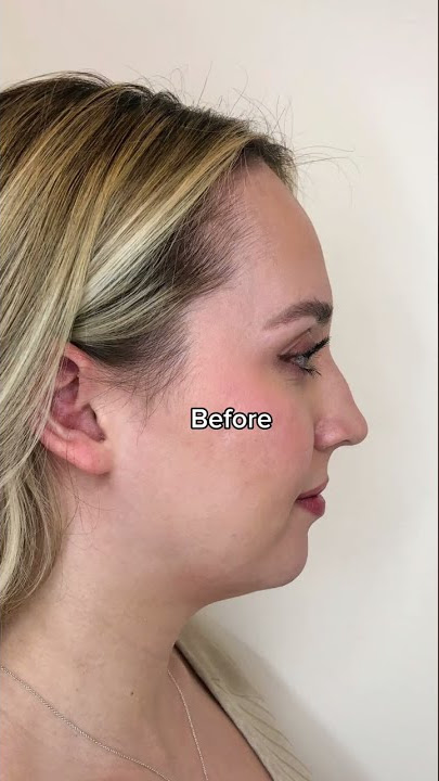 I got 3 Belkyra treatments to treat my #doublechin & these are the results!#beforeandafter #kybella