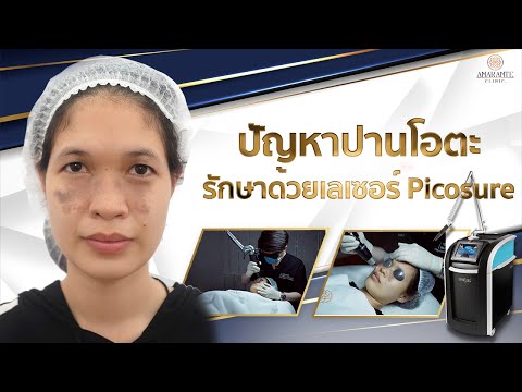 🚩ปัญหาปานโอตะ รักษาด้วยเลเซอร์ Picosure