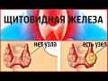 МОЙ ОПЫТ ИЗЛЕЧЕНИЯ УЗЛОВ ЩИТОВИДНОЙ ЖЕЛЕЗЫ, НЕ ДЛЯ ЭСТЕТОВ