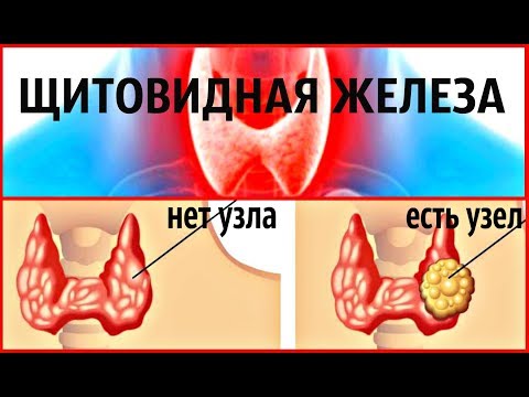 Как убрать узлы на щитовидной железе народными средствами