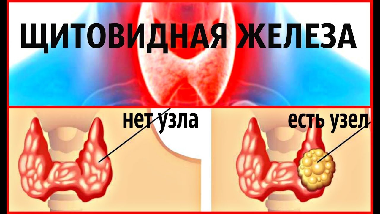 Народное лечение узлов щитовидной железы. Нетоксический многоузловой зоб. Узлы в щитовидной железе.