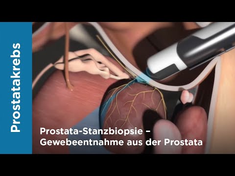 Prostata-Stanzbiopsie – Gewebeentnahme aus der Prostata