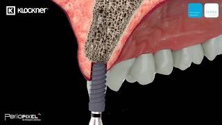 3D video Immediate soft and hard tissue alveolar reconstruction technique - Trailer screenshot 4
