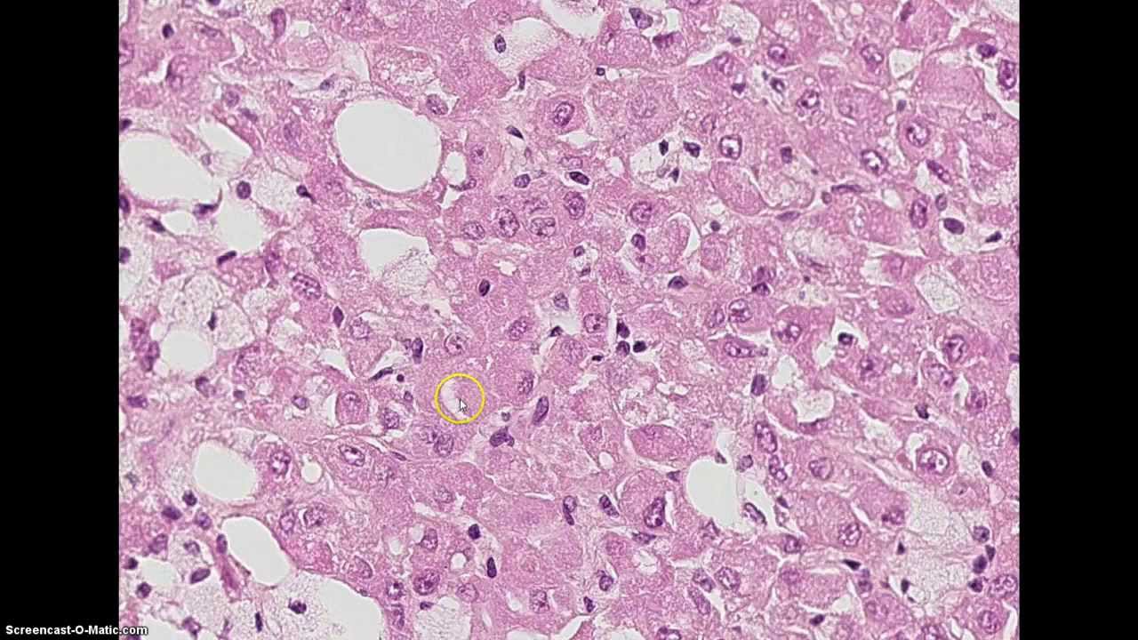 Case 4 Left Renal Mass YouTube