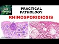 Practical Pathology: RHINOSPORIDIOSIS