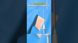 ABDOMINAL FLUID #healthawareness ABDOMINAL FLUID #healthawareness