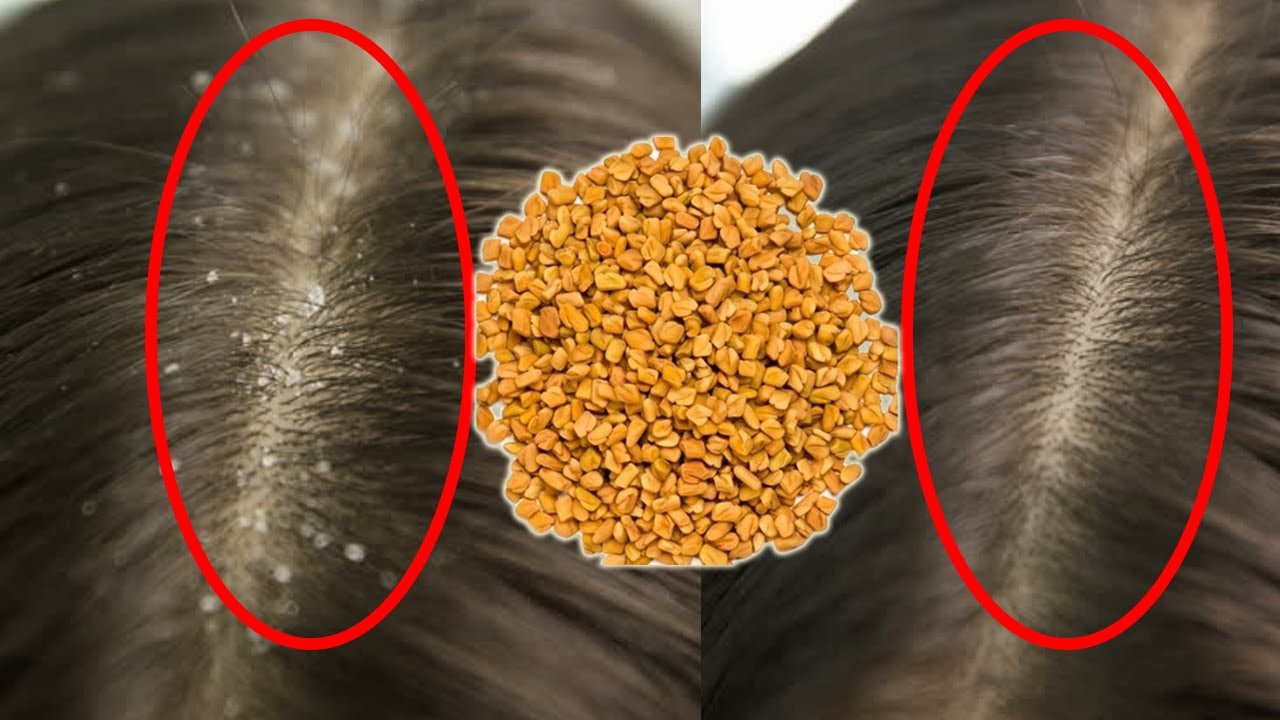 Remove Dandruff Completely With Fenugreek Seeds || #DIY Home Remedies -  YouTube