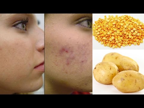 How To Get Rid Of Acne Scars, Hyperpigmentation & Dark Spots in just  Days