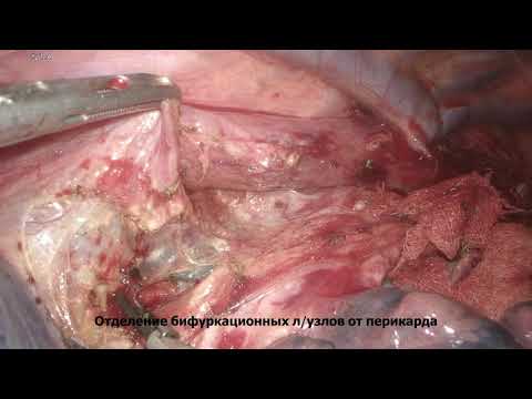 Thoracoscopic subtotal esophagectomy (Ivor Lewis)/Торакоскопическая операция Льюиса