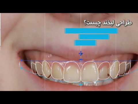 طراحی لبخند چيست؟