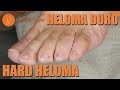 Hard heloma & nails cut [Podología Integral] Integral Podology