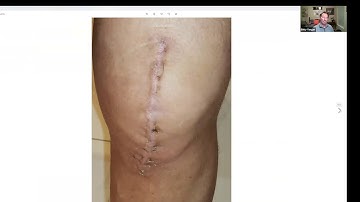 Lifewave X39   Dr Harmon Knee Replacement and the Heart