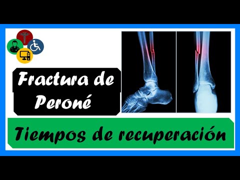 Vídeo: Fractura De Peroné: Tipos, Tratamiento, Recuperación Y Más