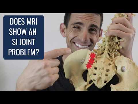 ვიდეო: აჩვენებს თუ არა MRI საკროლიაკას?