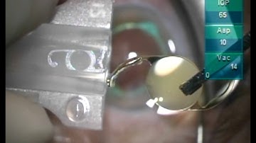Loading an IOL into the Cartridge