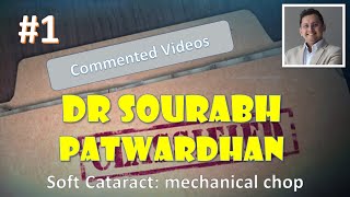 Commented Video Series #1 Soft cataract mechanical chop Dr Sourabh Patwardhan screenshot 2