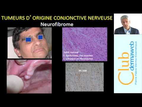 Vidéo: Caractéristiques Histopathologiques De L'hyperplasie Condylienne Et De L'ostéochondrome Condylien: Une étude Comparative