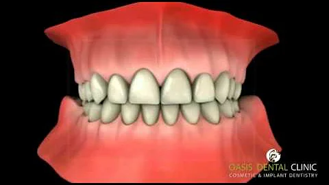 Teeth Whitening Procedure