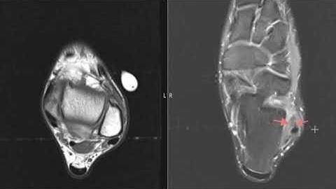 Anterior talofibular ligament complete tear recovery time