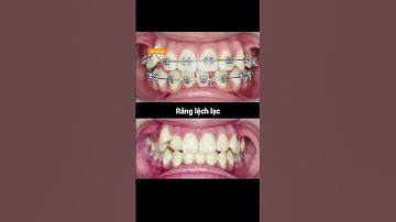 Cận cảnh sự thay đổi khi niềng răng khấp khểnh