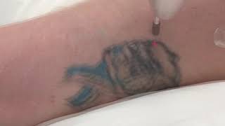 Laser Tattoo Removal Patch Test