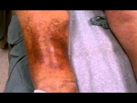 Video: Paano Gamutin Ang Isang Thrombophlebitic Vein Ulcer Na May Mga Herbs (postphlebitic Syndrome)