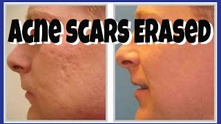 HOW TO COVER ACNE SCARS FLAWLESSLY | Tutorial | CHRIS GIBSON