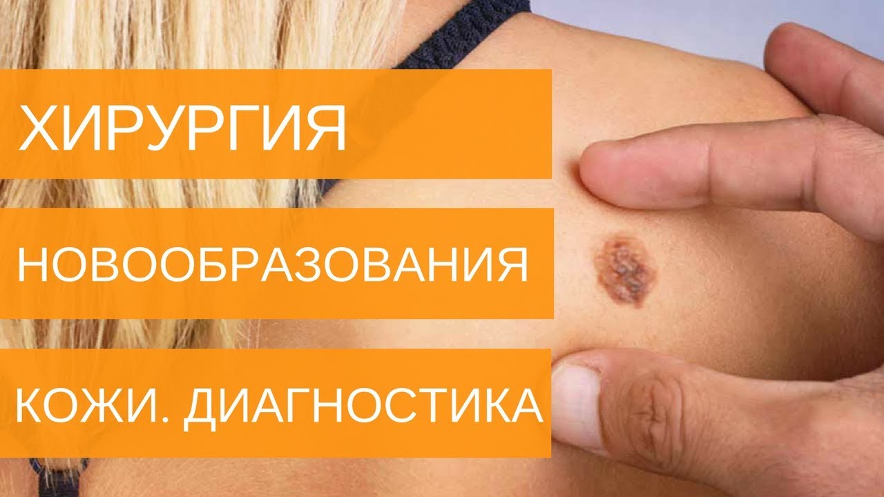 Как распознать МЕЛАНОМУ на ранних стадиях? - YouTube