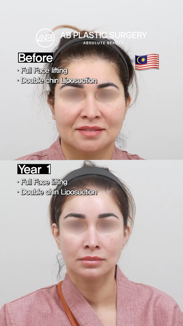 I Came to Korea for a Facelift — 1 Year Later #shorts