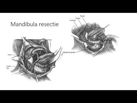 Video: Mondkanker (Gingiva Plaveiselkarsinoom) By Katte