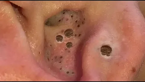 Blackhead Removal | Ear Blackheads Removal