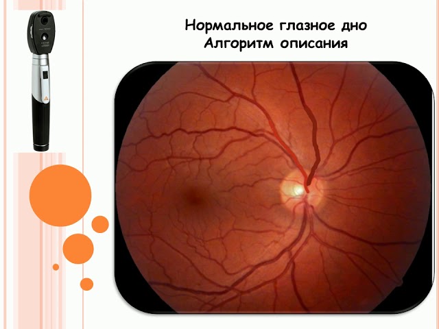 Норма глазного дна. Офтальмоскопия глазного дна норма. Глазное дно при офтальмоскопии норма. Непрямая офтальмоскопия глазного дна. Офтальмоскопия осмотр глазного дна алгоритм.