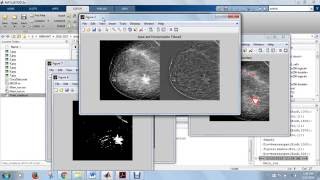 Detection of Breast cancer / Lesion Contour using MATLAB