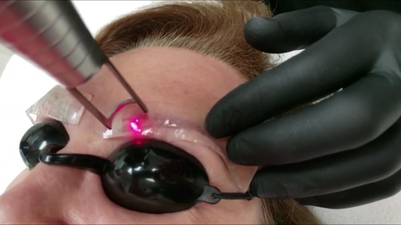 láser para cejas tatuadas