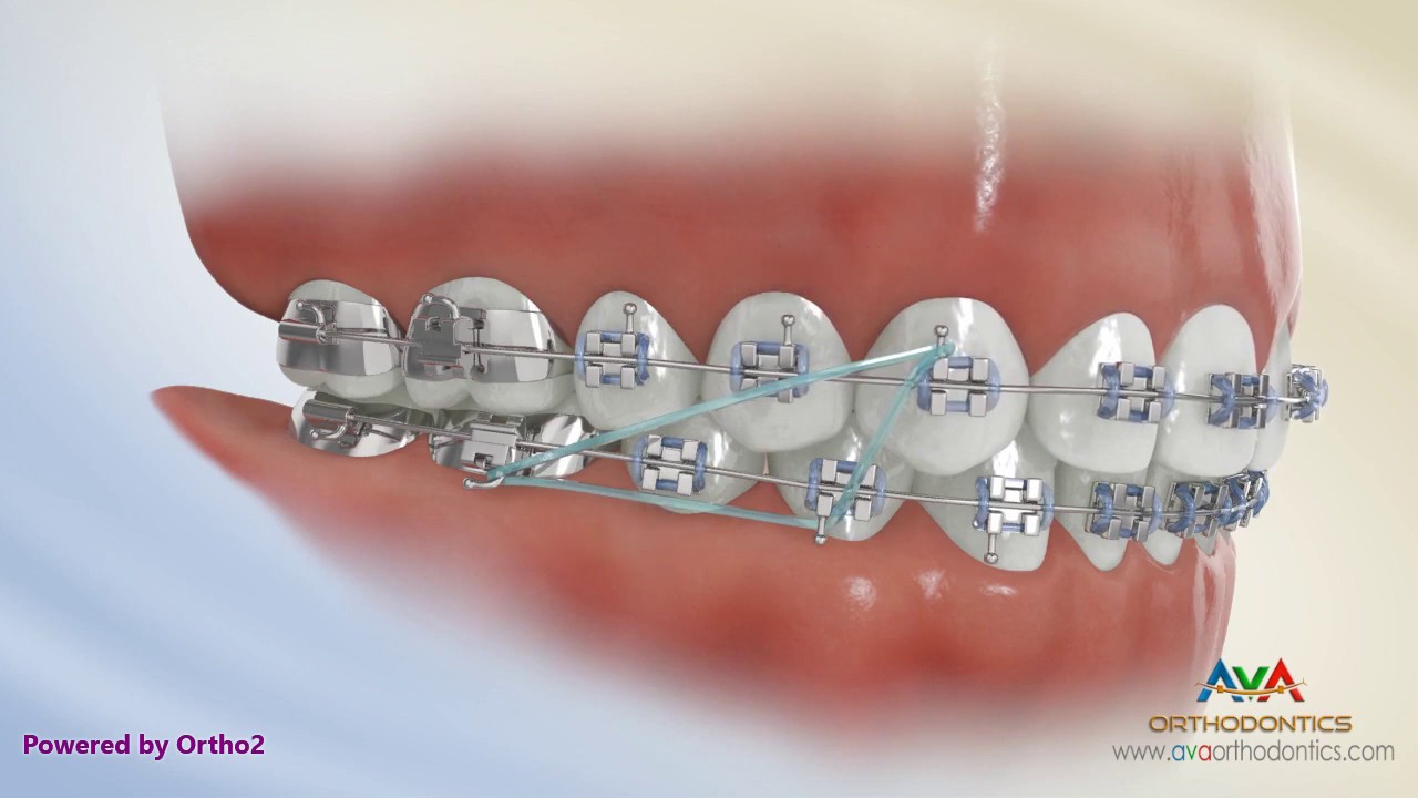 Rubber Bands for Braces  Hidden Valley Orthodontics