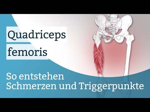 Quadriceps femoris Schmerzen, Triggerpunkte und deren Aktivierung