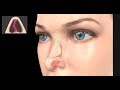 Deviated Septum Surgery (Septoplasty)