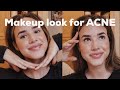 MAKEUP LOOK FOR ACNE PRONE SKIN
