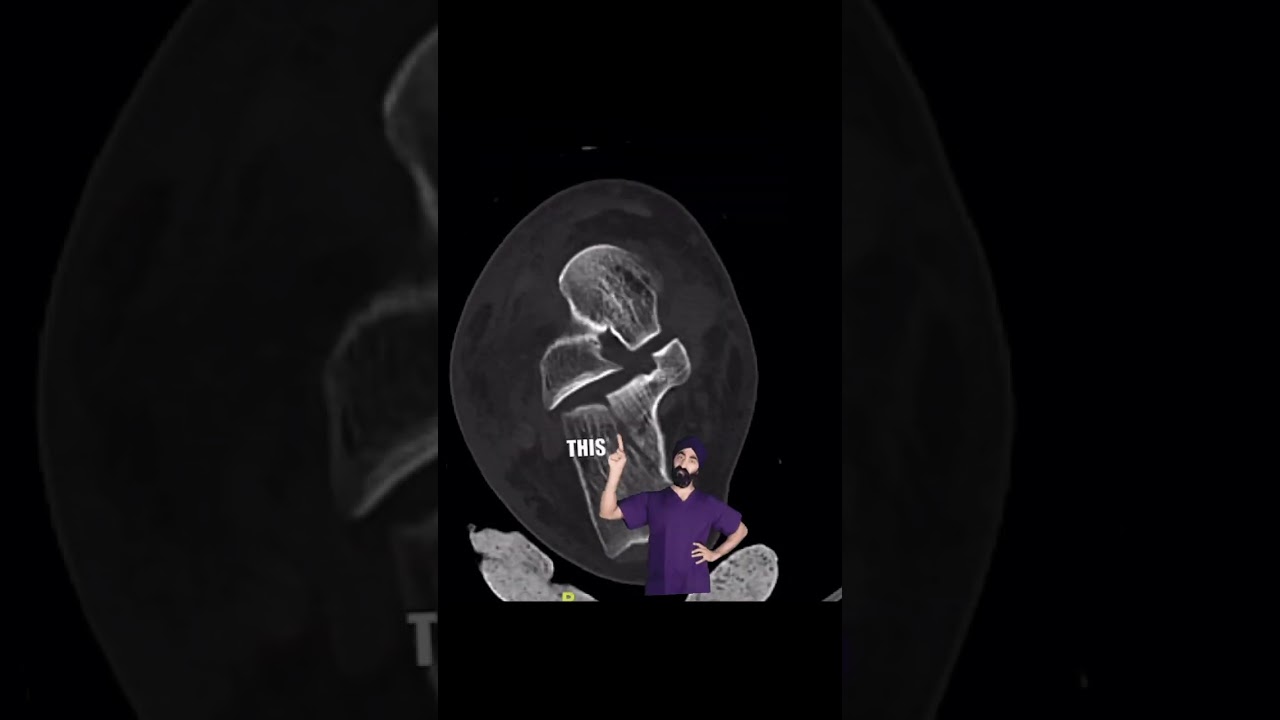 Calcaneus Articular Fractures