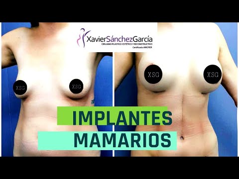 Implantes mamarios - Dr Xavier Sánchez García - Aumento de busto