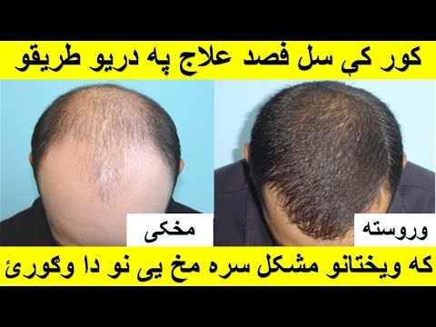 داسی اسانه په دریو طریقو د ویختانو د تویدلو مخنیوی وکری او نوی ویختان راررغون کری/how to stop hair