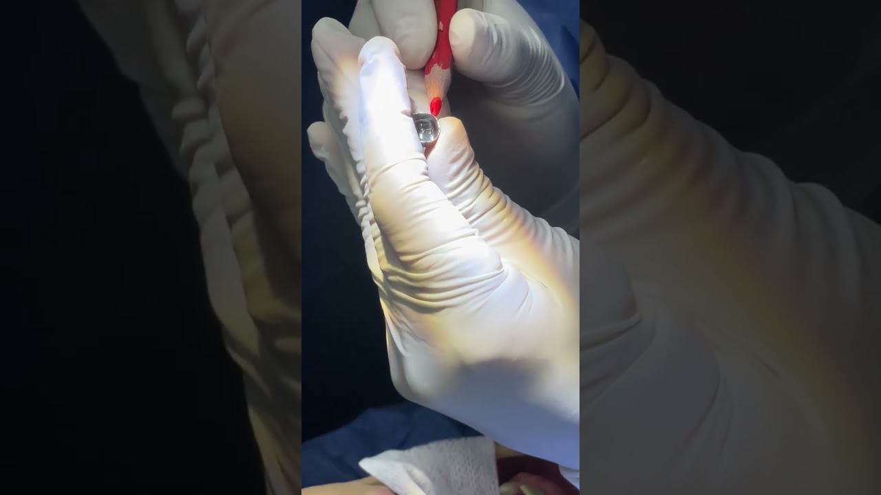 PREPARACIÓN DE CORONA METÁLICA Y CEMENTACIÓN ODP