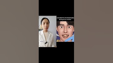 gắn mắc cài trông như thế nào?Dr Ngọc Yến #niengrangmaccai #niềng_răng