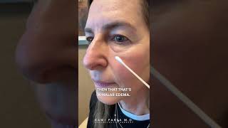 Avoid This Mistake When Treating Malar Edema | Kami Parsa, M.D. Oculoplastic Surgeon