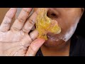 EASY DIY SUGAR WAX FOR BEGINNERS| How to remove facial hair permanently! | PCOS |Keiona Celeste