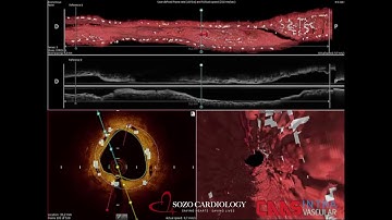 Optical Coherence Tomography (OCT)
